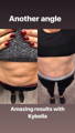 Woman's abdomen before and after Kybella to correct liposuction irregularities 