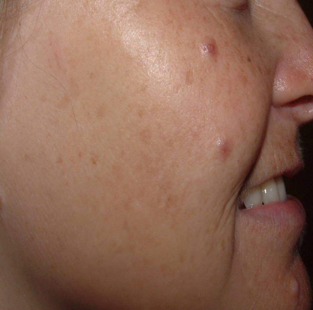 Intense Pulsed Light Pigmentation Removal Before