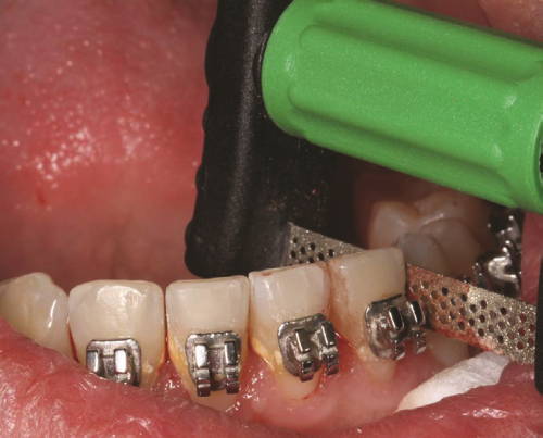 green handle strip reducing enamel on teeth with brackets