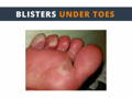 Blisters under toes