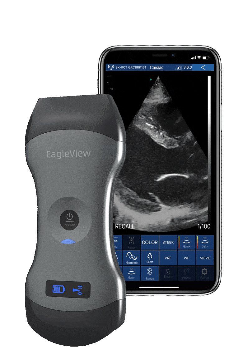 El ultrasonido Doppler portátil inalámbrico Wellue EagleView muestra una imagen cardíaca en el teléfono inteligente.