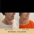 Marionette Line Filler Wilmslow Before & After Dr Sknn