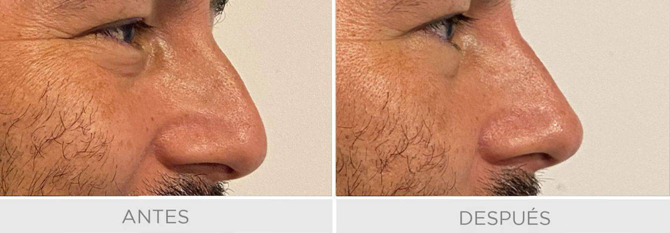 nariz sin cirugia rellenos buenos aires
