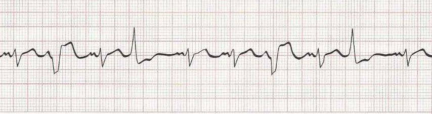Sinus Rhythm with multifocal PVCs (PVCs look different from each other)