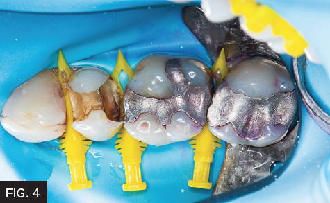 The Bioclear Method - Step 2: removal of carious dentin