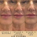 Lip Fillers Wilmslow with Anti-wrinkle injections