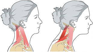 neck pain computer ergonomic