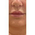 Dermal Fillers - Lip Fillers - Before