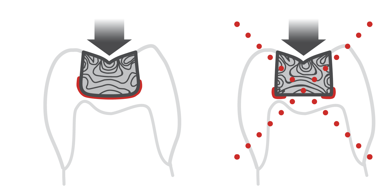 how to prevent formation of microcracks when removing old amalgam restoration