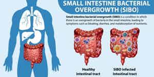 Small Intestine Bacterial Overgrowth Natural Treatment with Timeline