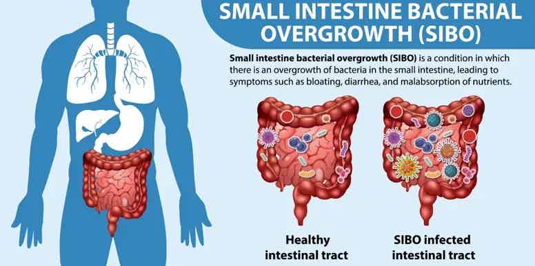 Small Intestine Bacterial Overgrowth Natural Treatment with Timeline