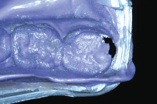 Fractured crown impression with removed pieces