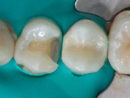 Tooth prepared and rubber dam isolation placed.