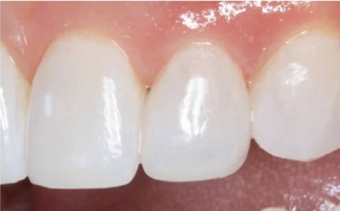 upper teeth after restoration, no gaps
