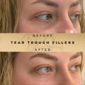 tear trough fillers Dr Sknn Before & After Picture