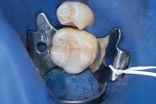 tooth prepared for restoration with rubber dam and metal clamp in place
