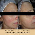 Redness Before & After Pictures Dr Sknn Wilmslow Cheshire