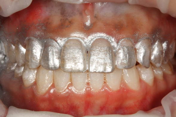 Upper teeth covered in silver dust