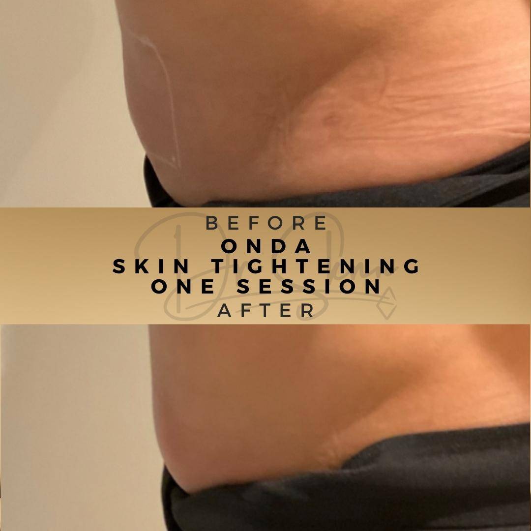 Non Surgical Skin Tightening Wilmslow Before & After Dr Sknn