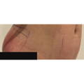 ONDA - Non-surgical Skin Tightening / Fat Reduction - Three Area - AFTER