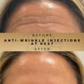 Forehead Anti-Wrinkle Injections Wilmslow Dr Sknn Before & After Picture
