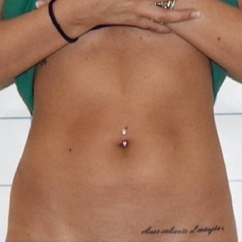 Dr Sknn Non-Surgical Fat Reduction, Cellulite & Skin Tightening After