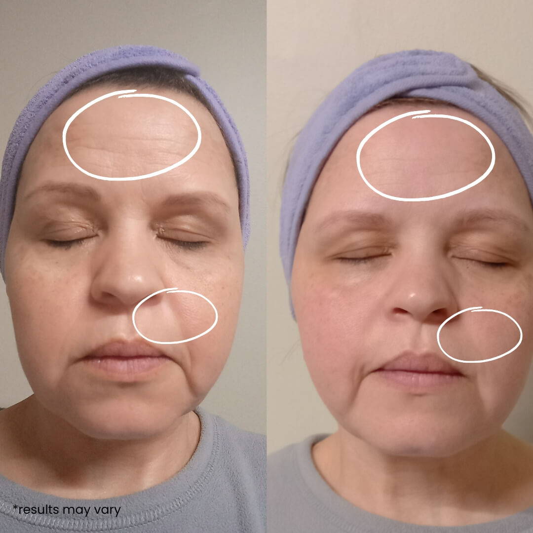 The RayJuvenate Wand before and after picture results one