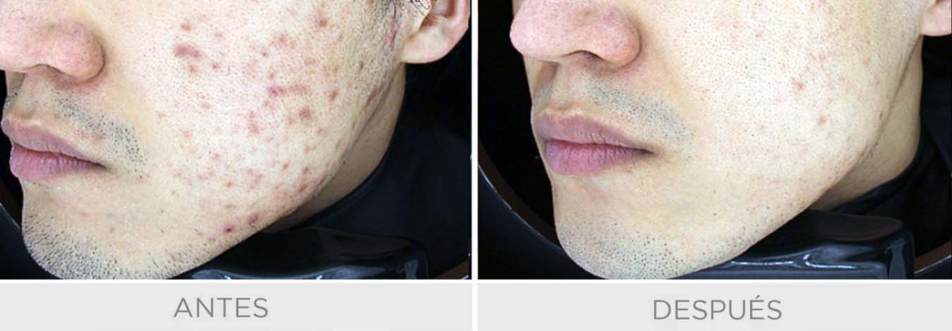 exosomas cicatrices acne