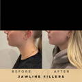 Jaw Fillers Wilmslow Before & After Dr Sknn