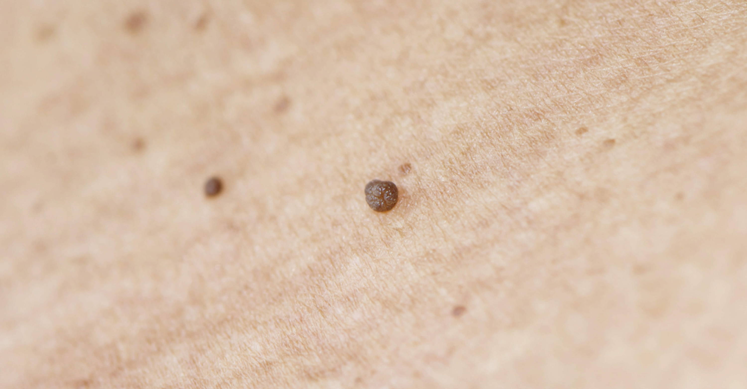 test What Are Skin Tags?