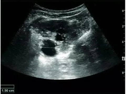 Renal pelvis dilated size in transverse section, scanned by EagleView portable ultrasound