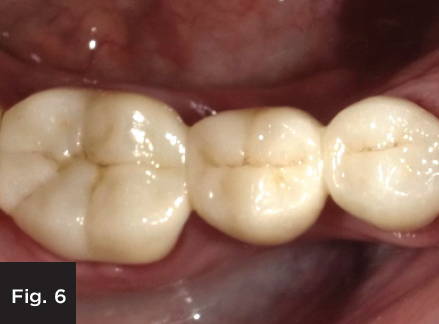 the image shows the final monolithic zirconia restoration in a mouth, occlusal view