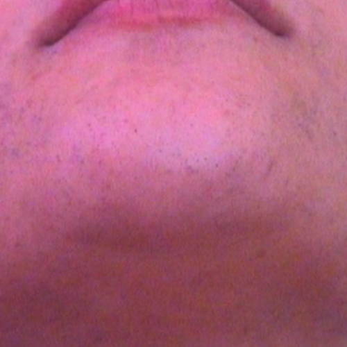 Intense Pulsed Light Hair Reduction - AFTER
