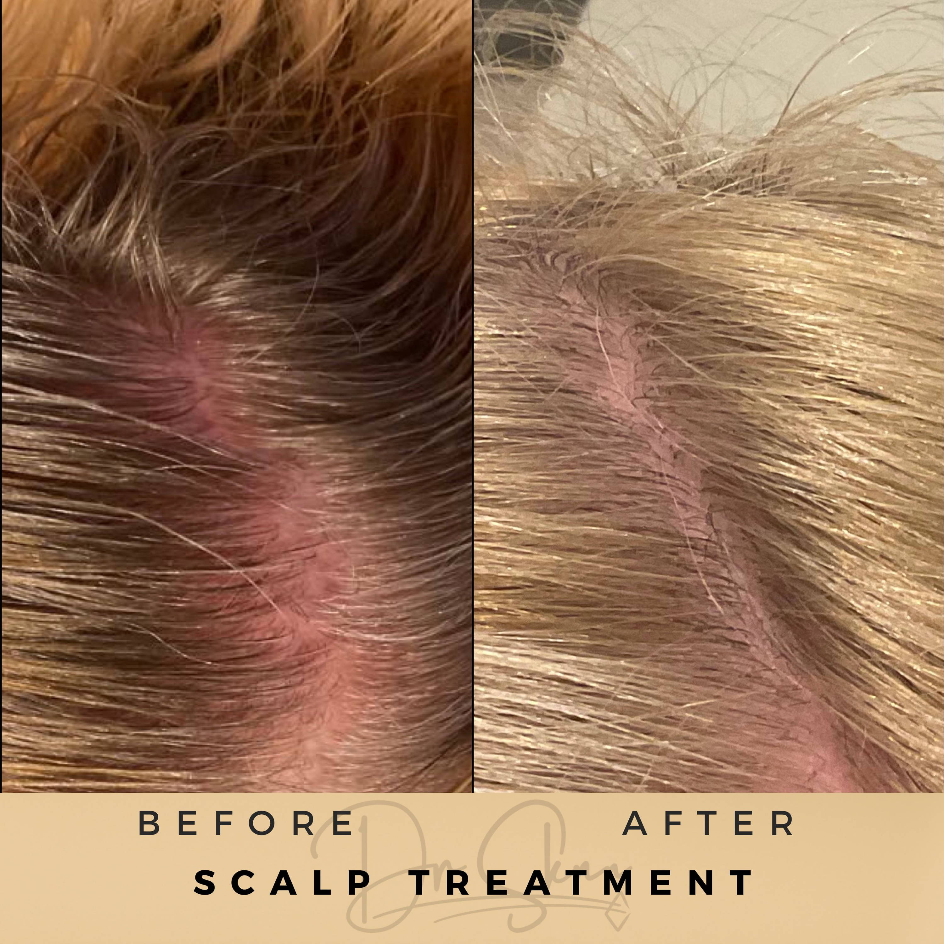 Scalp Treatment Wilmslow Before & After Dr Sknn