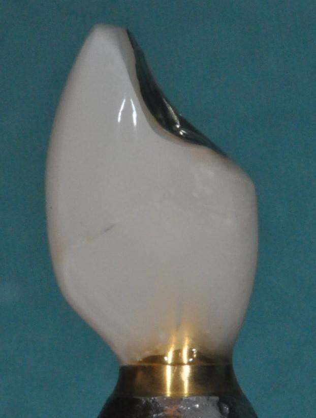 Temporary restored tooth sideview