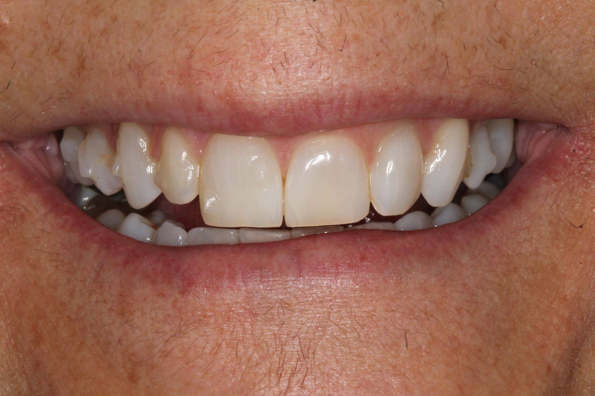 Before procedure smile close-up