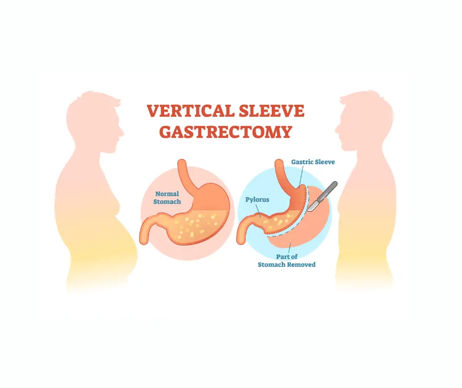 Gastric Sleeve Bariatric Surgery & Weight loss in dubai