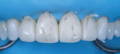 Pencil aligned incisors