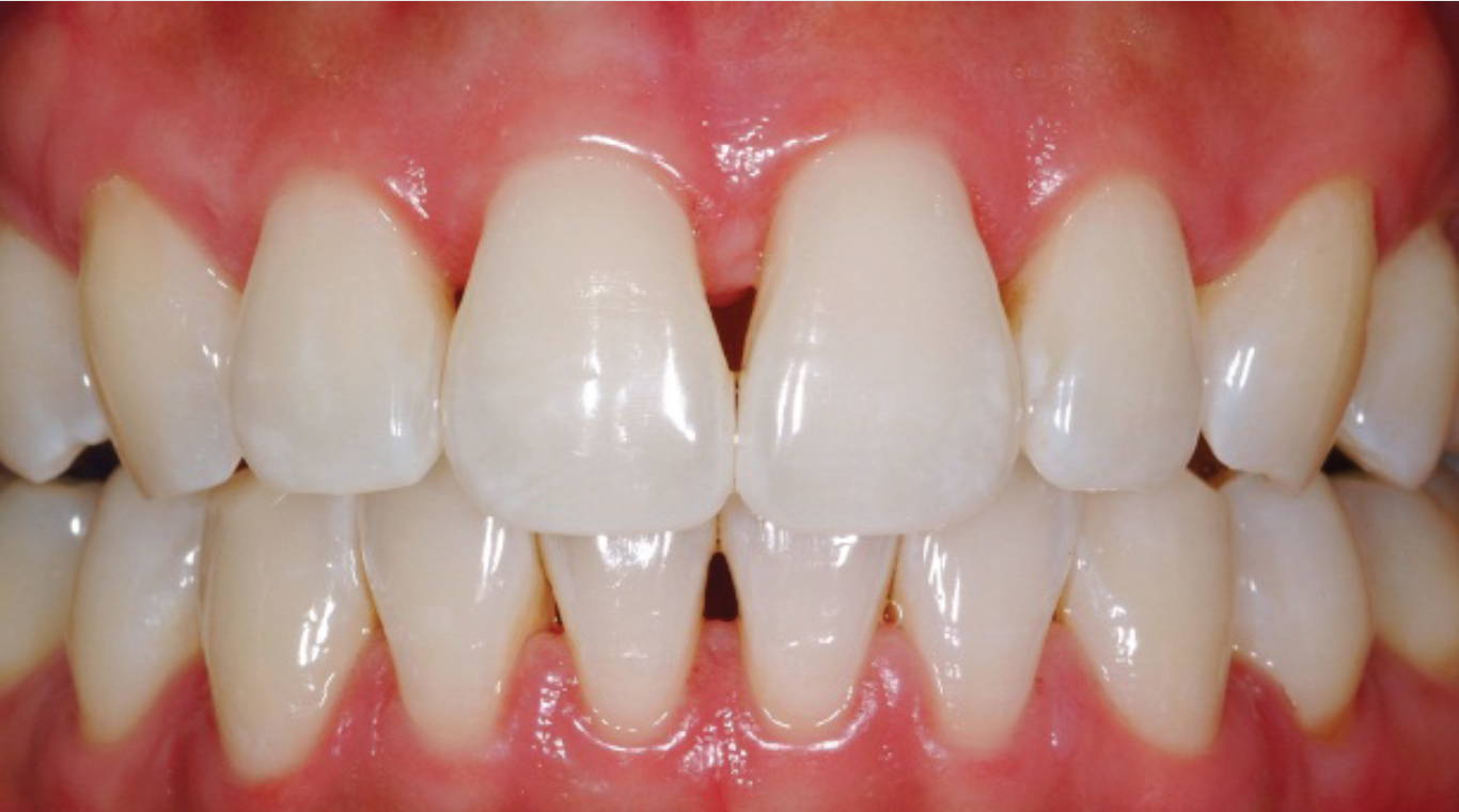 Pre-op image with patient teeth and the black triangles between the teeth