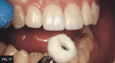 Cotton Wheel polishing tooth