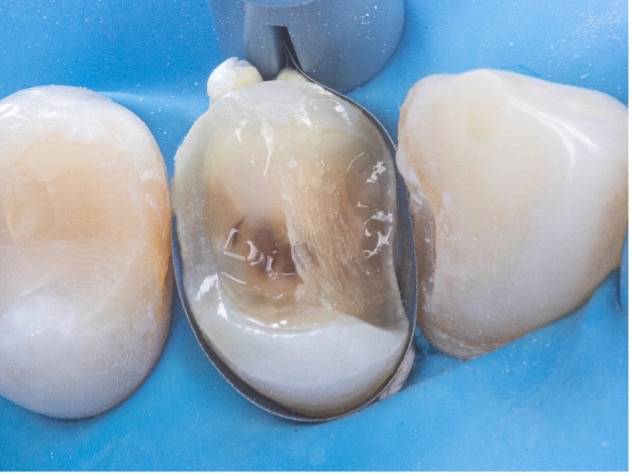 Exposed tooth with layer of adhesive and resin