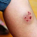 stun_guns_tasers_cause_skin_burns_bruises_puncture_wounds