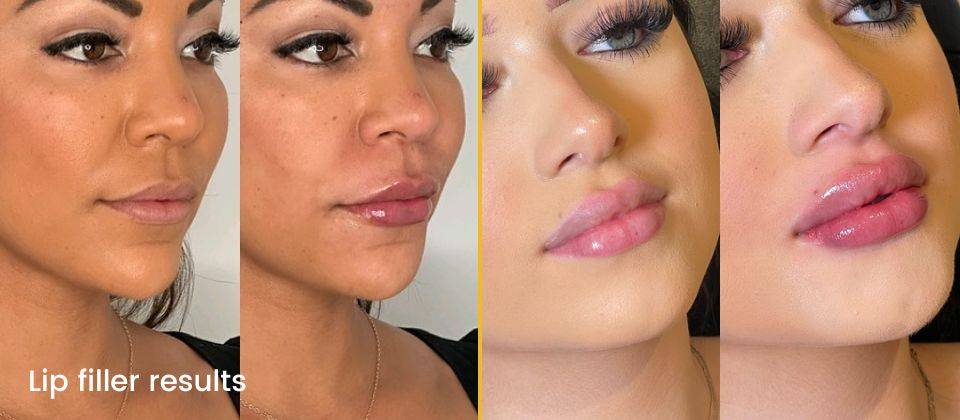 botox, juvederm before and after images