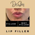 Lip Fillers Wilmslow with Anti-wrinkle injections