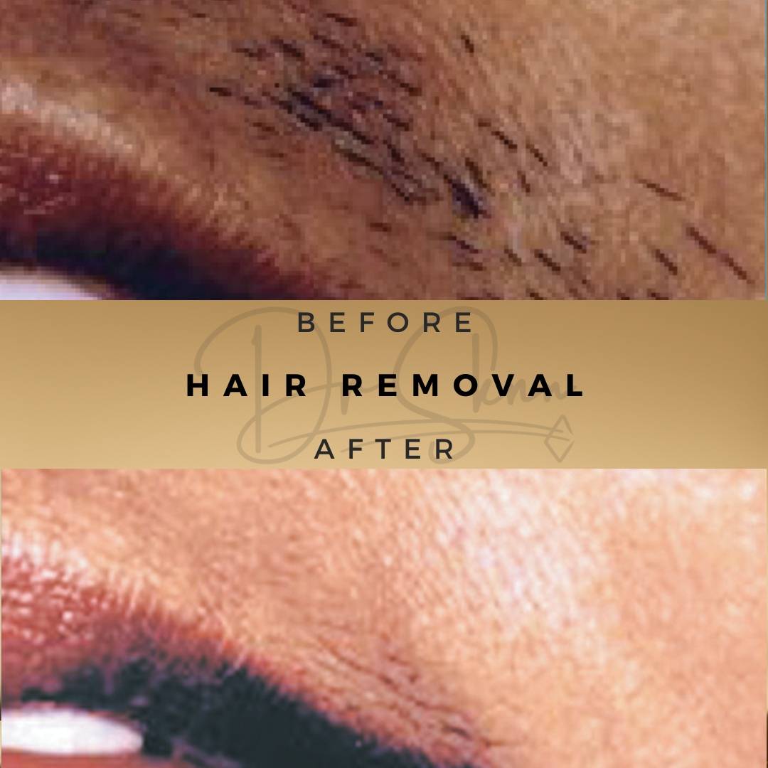 Laser Hair Removal Wilmslow Before & After Dr Sknn