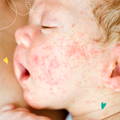 Baby's Arm with Eczema | The Milky Box
