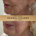 Marionette Line Filler Wilmslow Before & After Dr Sknn