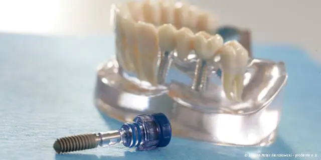 Zahnimplantate - Moderne Implantat-Systeme von renommierten und zertifizierten Herstellern