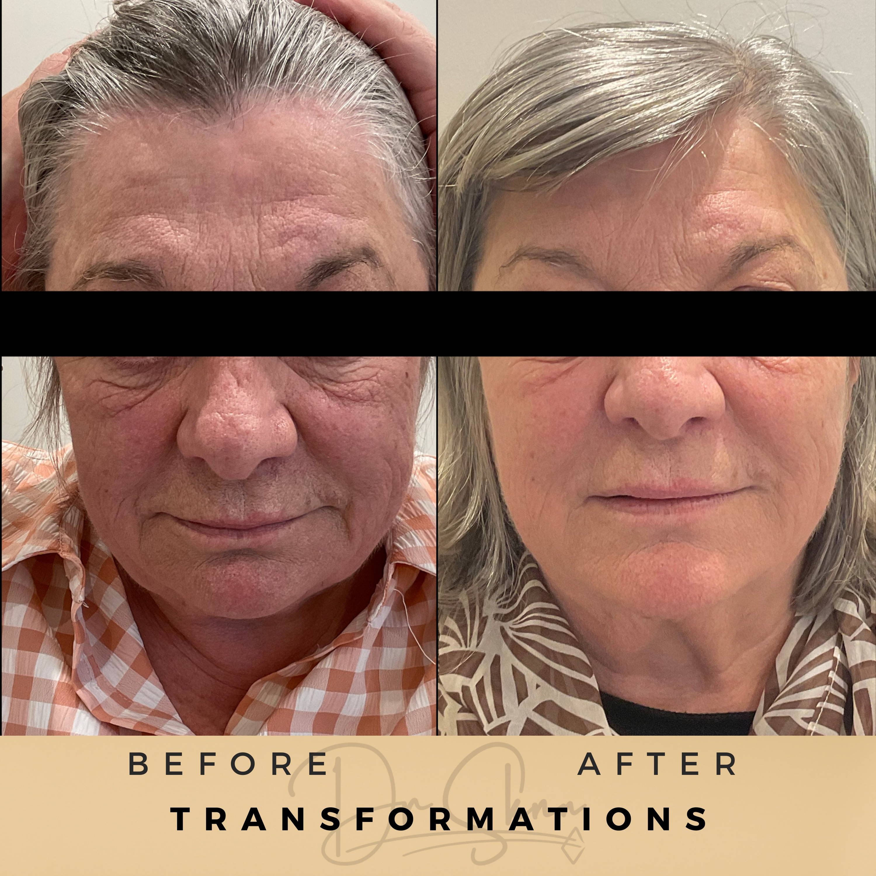 Non Surgical Aesthetics Wilmslow Before and Afters