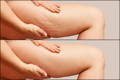 Vorher Nachher Vergleich Lymphdrainage